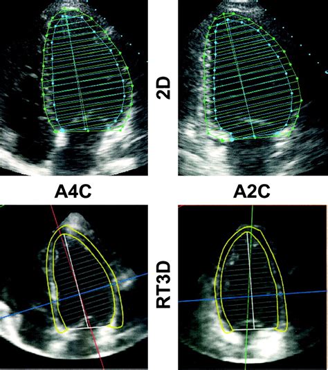 left ventricular mass 